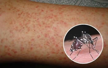 Những dấu hiệu của bệnh sốt xuất huyết
